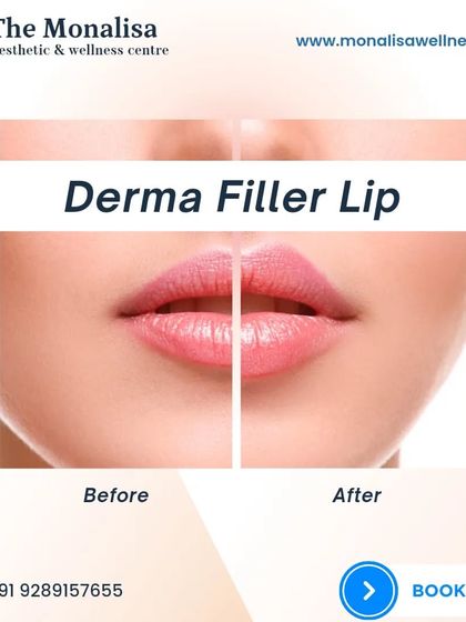 A simple yet effective before-and-after of a derma filler lip treatment. The 'after' image shows enhanced volume and a more defined shape, resulting in a fuller, more balanced pout.