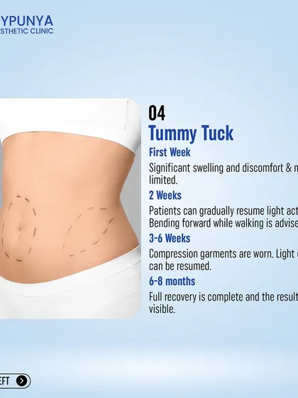 This is the recovery timeline for a tummy tuck. It is a more involved recovery, with light activities resuming at 2 weeks and full recovery taking 6-8 months.