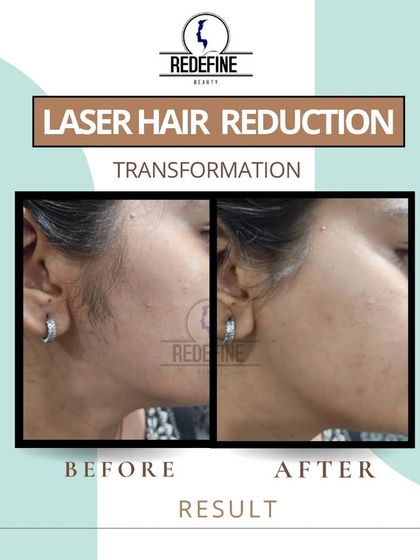 Another look at a successful facial hair removal on the sideburn area. Our goal is to make your skin smooth and even-toned, so you feel confident without makeup.