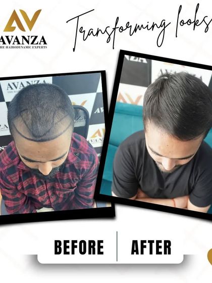 Another example of our precise hairline design and the excellent density achieved in the final result. The new hair blends perfectly with his existing hair.