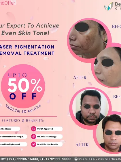 This graphic shows before-and-after results for laser pigmentation removal, along with a special offer. My focus is on using safe, quality-ensured technology to help you achieve an even skin tone.