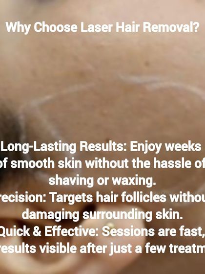 Here we outline the key benefits of choosing laser hair removal for your face. The precision of our lasers targets only the hair follicle, ensuring the surrounding skin is unharmed while providing long-lasting smoothness.