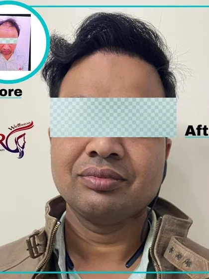 This client came to us seeking a solution for frontal hair loss. The after photo shows a successful hair restoration, creating a natural and fuller look that frames his face perfectly.