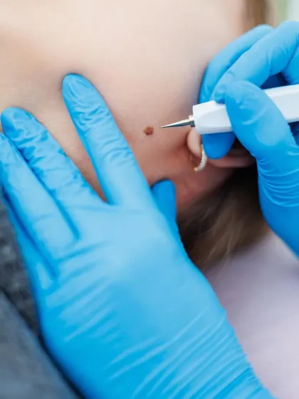 A close-up view of a mole removal procedure on the face. Using specialized tools, I ensure the removal is precise and cosmetically elegant, which is especially important for visible areas like the face and neck.