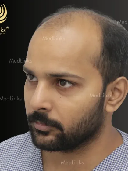 Another angle showing the extent of hair loss before treatment. A proper diagnosis helps us understand the donor capacity and plan for optimal coverage and density.