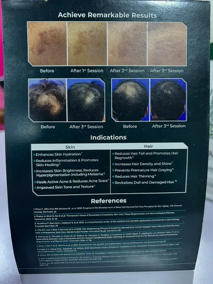 A closer look at the before and after results from exosome therapy. For hair, it shows a significant increase in density and coverage after just three sessions, proving its effectiveness in combating hair thinning.