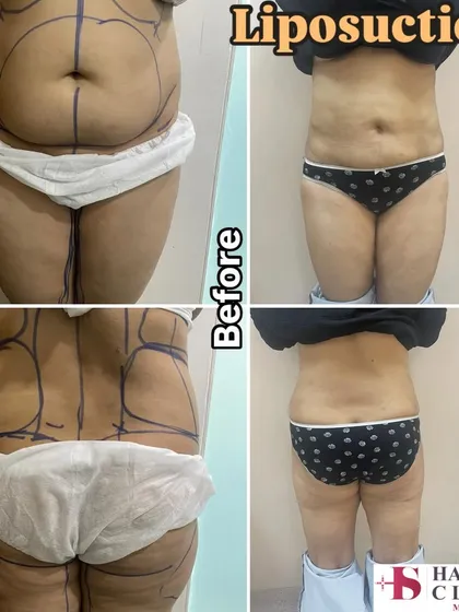 A comprehensive liposuction result for the abdomen and back. The pre-operative markings show the areas I targeted to remove localized fat deposits. The after photo displays a significantly improved body shape and proportion, highlighting how body sculpting can address areas resistant to diet and exercise.