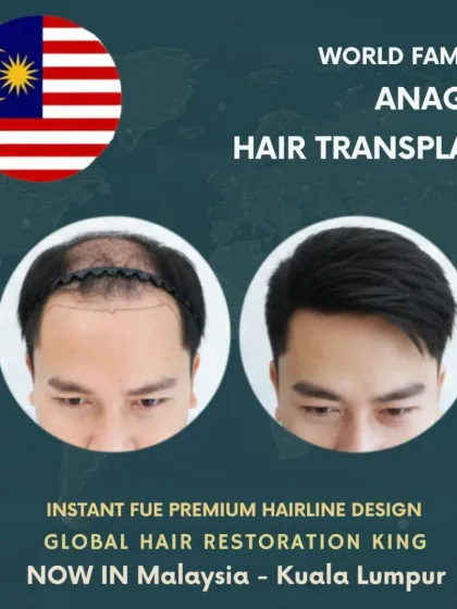 This before and after comparison highlights a typical case we handle at our Kuala Lumpur clinic. Notice the carefully designed hairline and the dense packing achieved with our Instant FUE technique for a completely natural look.