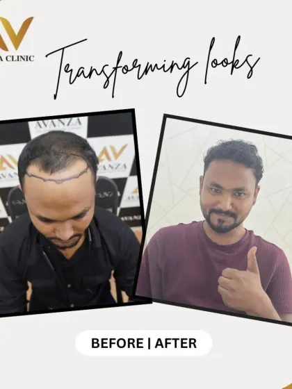 The client's happy thumbs-up says it all. We rebuilt his hairline and added density, resulting in a transformation he is clearly thrilled with.