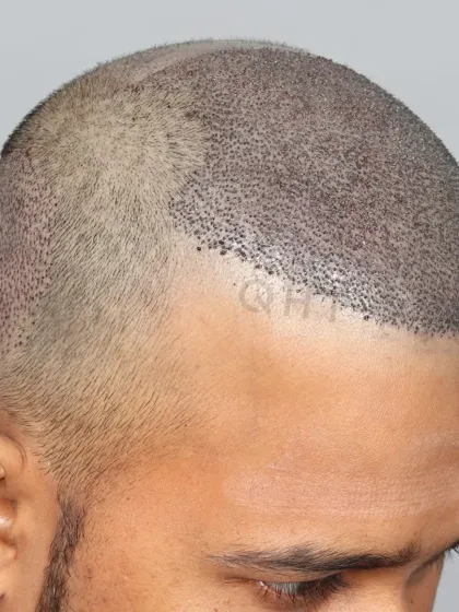 High-density, high-impact. 5000 grafts placed to restore the hairline and mid-scalp for a powerful comeback.