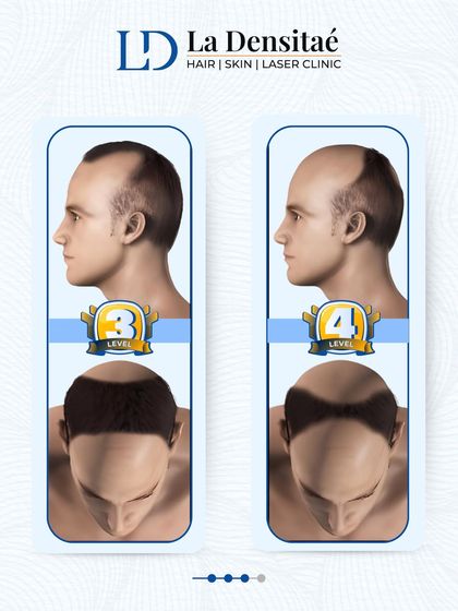 This graphic displays stages 3 and 4 of hair loss. Stage 4 and beyond is considered the danger zone, but with the right intervention, it's still possible to make a comeback.