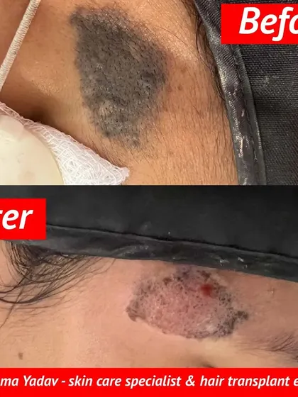 This before-and-after image shows the removal of a hairy nevus, a type of birthmark. Treating deeper or more complex lesions like this requires a careful, expert approach to ensure the best possible cosmetic outcome. I assess each case to determine the most suitable removal method.
