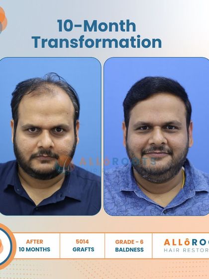 This 10-month transformation is a powerful example of tackling advanced Grade 6 baldness. With 5014 grafts, we achieved remarkable coverage and density, as seen from all angles.