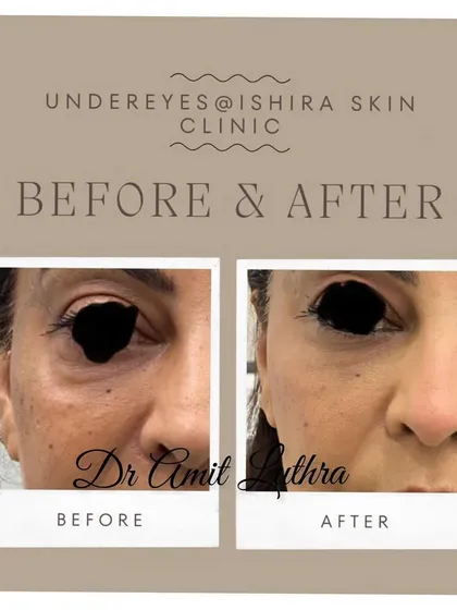 Here is another example of under-eye correction. By carefully placing filler in the tear trough, I can smooth the transition between the cheek and the under-eye, resulting in a younger, fresher look.