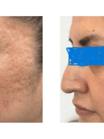 This transformation was achieved with MNRF, which combines microneedling and radiofrequency to boost collagen and tighten the skin. It is one of my preferred treatments for deep dermal rejuvenation.