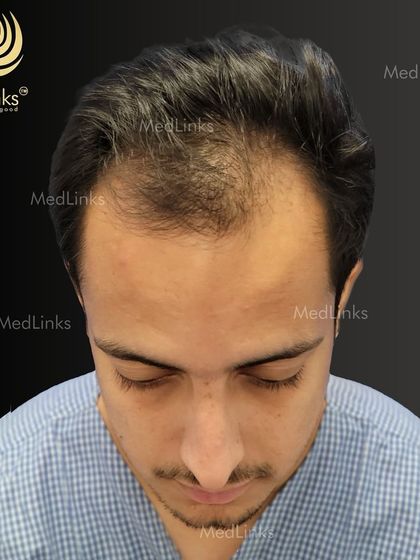A top-down view of the patient's hair loss before the transplant.