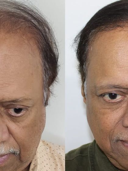 A frontal view showcasing the complete transformation. This result demonstrates that it's never too late to invest in your confidence.