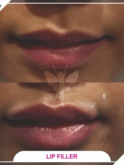 A beautiful, natural-looking lip enhancement using dermal fillers. I focused on adding subtle volume and definition to create a fuller, more hydrated appearance while maintaining the natural shape of the lips.