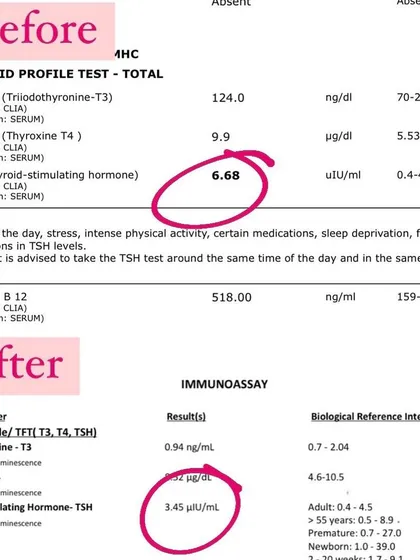 We believe in results you can see. This client's Thyroid Stimulating Hormone (TSH) level dropped from an elevated 6.68 to a healthy 3.45 in just two months on our program, demonstrating the power of functional nutrition in reversing hormonal imbalances.