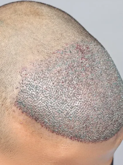 A high-density transformation in progress. 4000 grafts were implanted to rebuild the hairline and cover the mid-scalp.