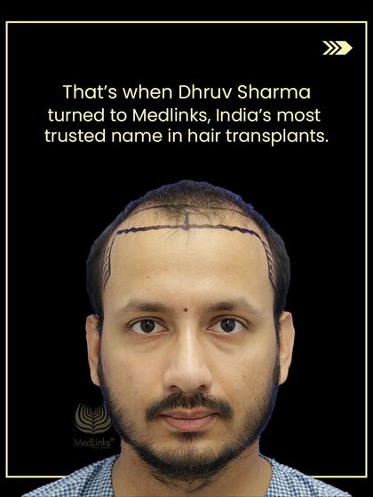 This image shows the crucial hairline design phase for Dhruv, where we marked the new hairline before the transplant.