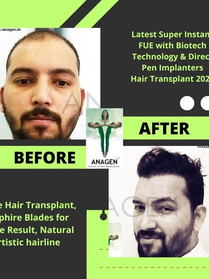 This before and after image shows another successful transformation using our advanced hair transplant techniques, resulting in a full and natural look.