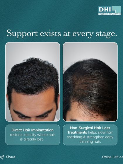 **Support Exists at Every Stage:** Whether you need non-surgical treatments to slow early thinning or Direct Hair Implantation to restore lost density, we have a solution. This image shows that our expert-led treatments are designed for your specific stage and goals.