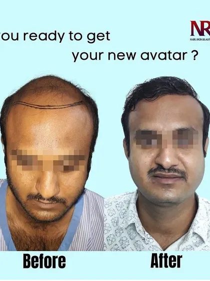 This is the new avatar we help our clients achieve. On the left, you see significant hair loss due to male pattern baldness, and on the right, the final result after our high-density Micro-FUE hair transplant. This transformation took place over 12 months.