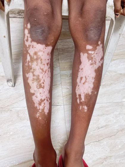 This image shows extensive Vitiligo, or safed daag, covering large areas of the legs. My first goal in such cases is to immediately stop the condition from spreading further.