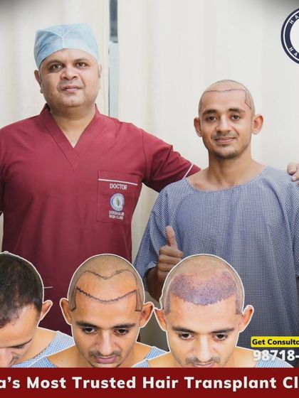 A great result for this patient with Grade 3 baldness. We used 3380 grafts to restore his hairline and density, and this collage shows the clear transformation.