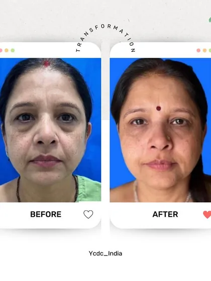 A subtle change can make all the difference. For this patient, I used hyaluronic acid fillers to address under-eye hollows and restore volume to the cheeks. The result is a refreshed, more youthful appearance that looks completely natural, not "done". This is about graceful aging and enhancing your own features.