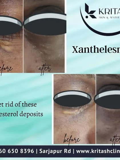 Here I have treated xanthelasma, the yellowish cholesterol deposits that appear on or near the eyelids. The images clearly show the significant cosmetic improvement after the deposits were carefully removed. I use various methods like laser, radiofrequency ablation, or peels, depending on your specific case.