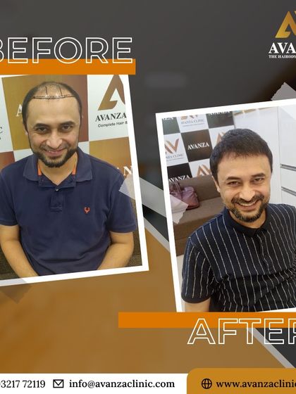A great example of a natural-looking hair transplant. The client is smiling and looks years younger with his restored hairline and density.