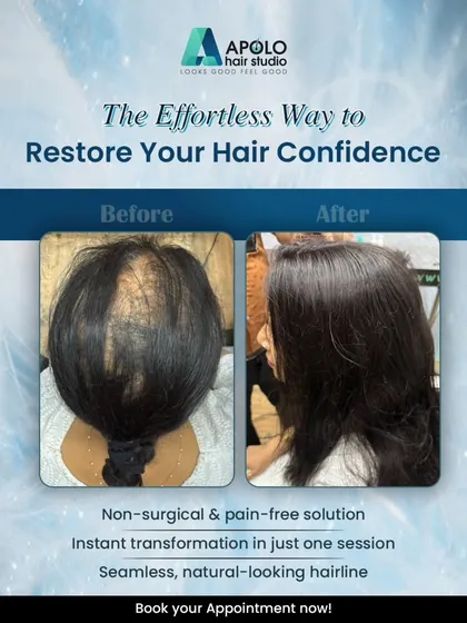 For our female clients experiencing hair thinning on the top of their scalp, we provide custom hair toppers. This before and after photo shows how we restored volume and coverage instantly, creating a natural-looking hairline with a pain-free solution.
