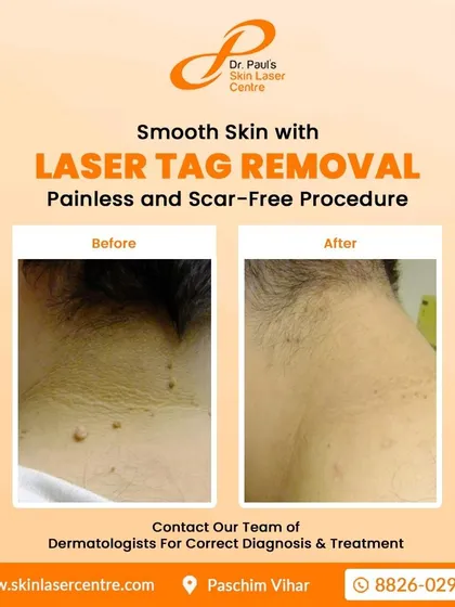 Skin tags on the neck are a common issue that I treat with laser tag removal. The procedure is painless and scar-free, leaving the skin smooth as shown in this before and after comparison.