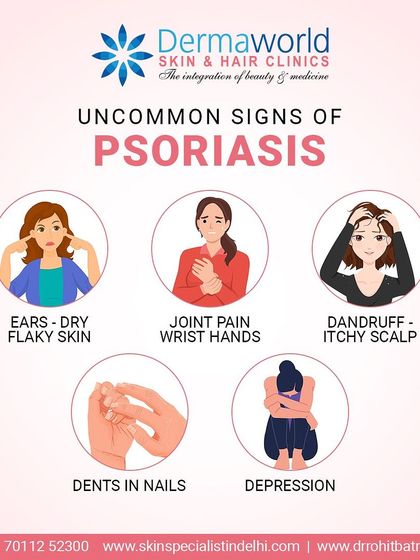 Psoriasis can show up in uncommon ways, such as joint pain, dents in nails, or a very itchy scalp that looks like dandruff. Recognizing these less obvious signs is important for getting a timely and accurate diagnosis.
