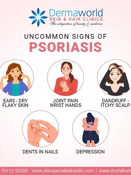 Psoriasis can show up in uncommon ways, such as joint pain, dents in nails, or a very itchy scalp that looks like dandruff. Recognizing these less obvious signs is important for getting a timely and accurate diagnosis.