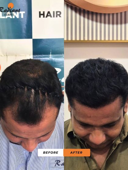 This top-down view demonstrates the excellent coverage we achieved for this patient, who was experiencing significant thinning in the crown area. The new hair provides impressive density.