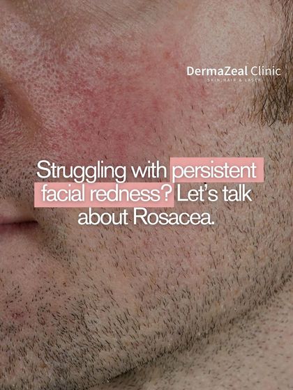 Struggling with persistent facial redness? Let's talk about Rosacea. It often appears as blushing or bumps, and the right treatment plan can help manage symptoms and reduce redness.
