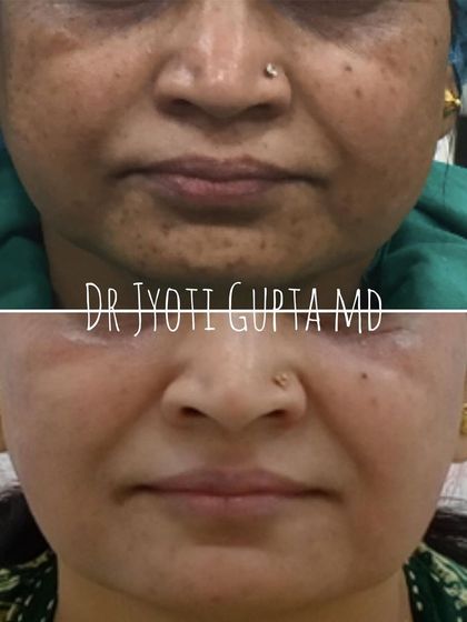 This patient's rejuvenation was achieved with a combination of dermal fillers, peels, and slimming BOTOX. The result is a lifted, more contoured facial structure and visibly improved skin quality, proving that a multi-faceted approach yields comprehensive results.