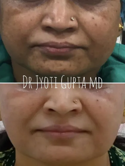 This patient's skin rejuvenation is the result of a combination plan using dermal fillers, chemical peels, and slimming BOTOX. It shows that a long-term, patient approach to skin maintenance yields beautiful results.