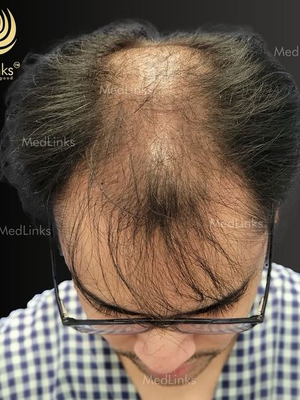 A top-down view of the patient's hair loss before the transplant.