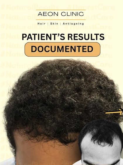We document every patient's results to ensure transparency and track progress. This collage shows the journey from baldness to a full head of hair.