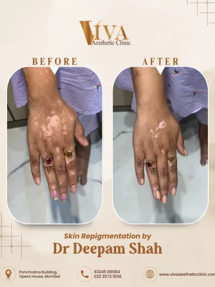 Here is another example of successful skin repigmentation on the hands, an area commonly affected by vitiligo. My treatment plans are designed to be safe and effective, helping patients regain confidence in their skin's appearance.
