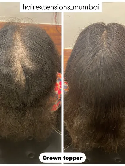 This before and after shows the effectiveness of our custom crown topper. It is designed to conceal hair thinning at the crown, blending perfectly with the client's natural hair for a fuller, more confident appearance.
