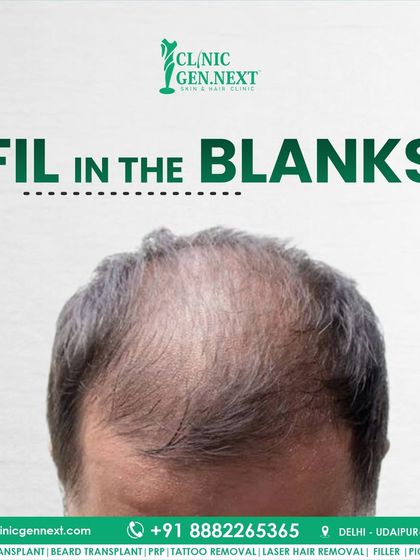 Fill in the blanks on your scalp. A hair transplant is the most effective way to restore hair to thinning or bald areas permanently.