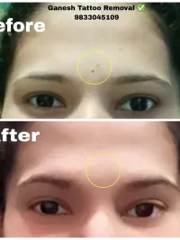 Laser Tattoo Removal