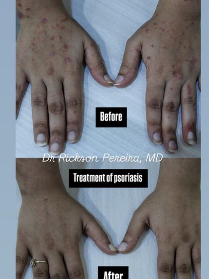Psoriasis on the hands can be particularly challenging for daily activities. This result shows a complete clearance, restoring comfort and function. Modern treatments offer hope for even the most persistent forms of psoriasis.