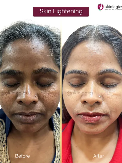 A frontal view of the skin lightening treatment results for the patient in images 37 and 38, showcasing the overall brightening and evening of the facial skin tone.