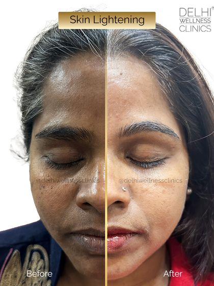 A split-view of the skin lightening results, highlighting the contrast between the treated and untreated skin for a clear demonstration of the outcome.